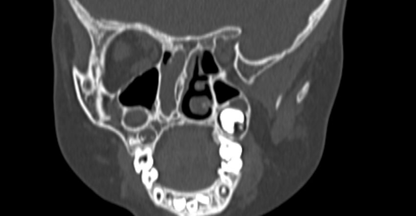 Choanal atresia (Radiopaedia 51295-56972 Coronal bone window 53).jpg