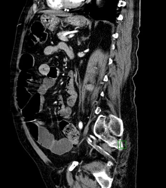 File:Cholangiocarcinoma with cerebral metastases (Radiopaedia 83519-98629 F 50).jpg