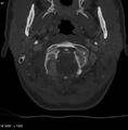Chondroblastoma - occipital condyle (Radiopaedia 5569-7304 bone window 10).jpg