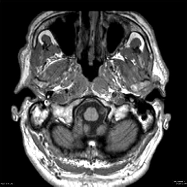 File:Chondrosarcoma of skull base- grade II (Radiopaedia 40948-43654 Axial T1 9).jpg