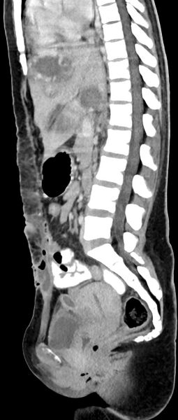 File:Choriocarcinoma liver metastases (Radiopaedia 74768-85766 C 98).jpg