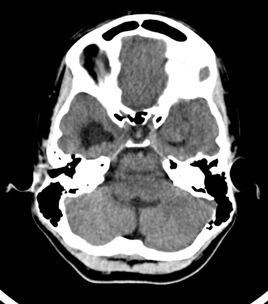 File:Choroid plexus carcinoma (Radiopaedia 91013-108552 Axial non-contrast 17).jpg