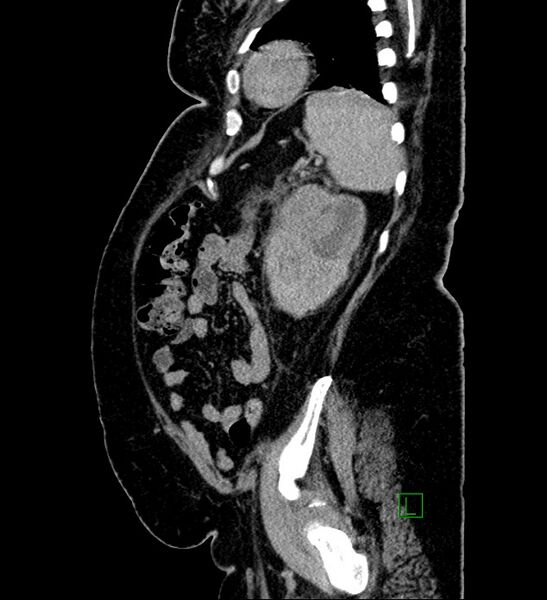 File:Chromophobe renal cell carcinoma (Radiopaedia 84239-99519 G 28).jpg