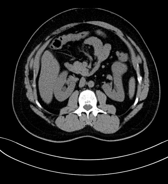 File:Chromophobe renal cell carcinoma (Radiopaedia 84286-99573 Axial non-contrast 21).jpg