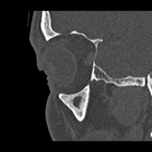 File:Chronic maxillary sinusitis (Radiopaedia 27879-28116 Sagittal bone window 4).jpg