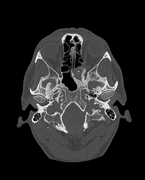 File:Chronic maxillary sinusitis caused by a foreign body (Radiopaedia 58521-65676 Axial bone window 206).jpg