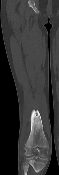 File:Chronic ostemyelitis of the femur with long sinus tract (Radiopaedia 74947-85982 Coronal bone window 51).jpg