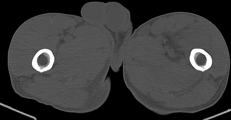 File:Chronic osteomyelitis (with sequestrum) (Radiopaedia 74813-85822 Axial 79).jpg