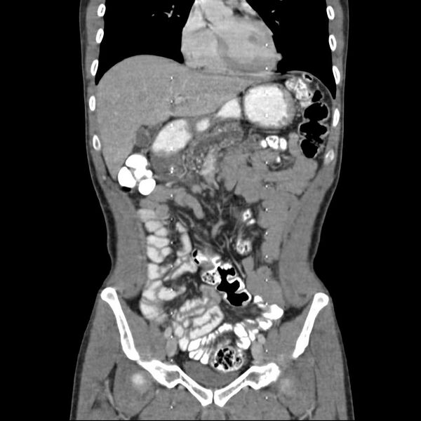 File:Chronic pancreatitis (Radiopaedia 21022-20949 C 6).jpg