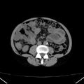 Chronic pancreatitis (Radiopaedia 23132-23172 Axial non-contrast 48).jpg