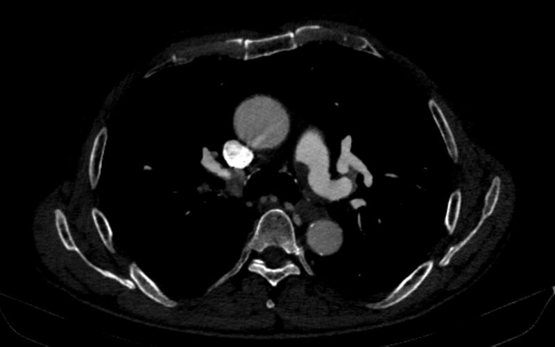 File:Chronic pulmonary embolism (Radiopaedia 91241-108843 B 75).jpg