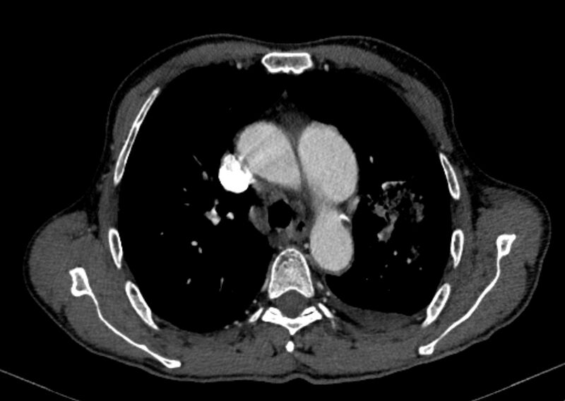 File:Chronic pulmonary embolism with bubbly consolidation (Radiopaedia 91248-108850 C+ arterial phase 45).jpg