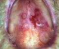 Cicatricial pemphigoid (DermNet NZ immune-cicpem).jpg