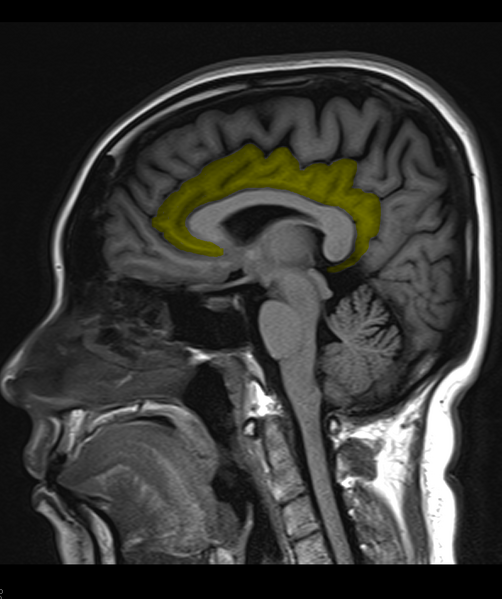 File:Cingulate gyrus anatomy (Radiopaedia 35221).PNG