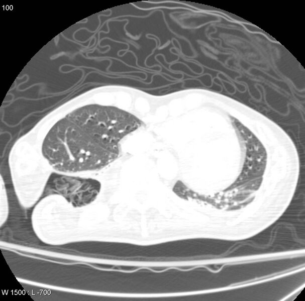 File:Clagett thoracotomy (Radiopaedia 8568-9403 Axial lung window 8).jpg