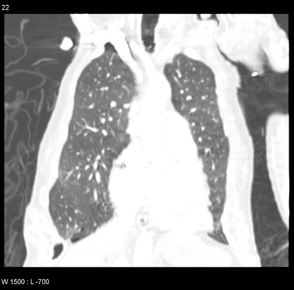 File:Clagett thoracotomy (Radiopaedia 8568-9403 Coronal lung window 22).jpg