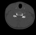 Clay-shoveler fracture (Radiopaedia 22568-22590 Axial bone window 48).jpg