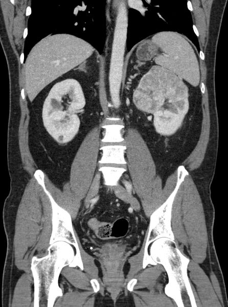 File:Clear cell renal cell carcinoma (Radiopaedia 61449-69393 F 28).jpg