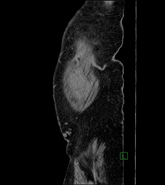 File:Closed-loop small bowel obstruction-internal hernia (Radiopaedia 78439-91096 C 135).jpg