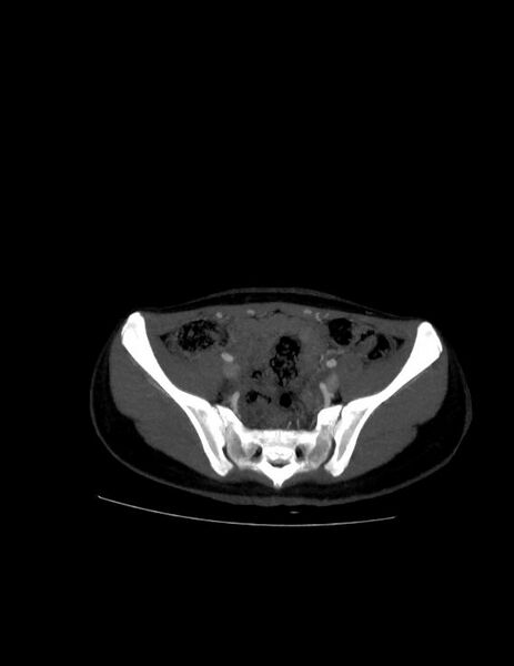 File:Coarctation of the aorta (Radiopaedia 27458-27657 D 43).jpg