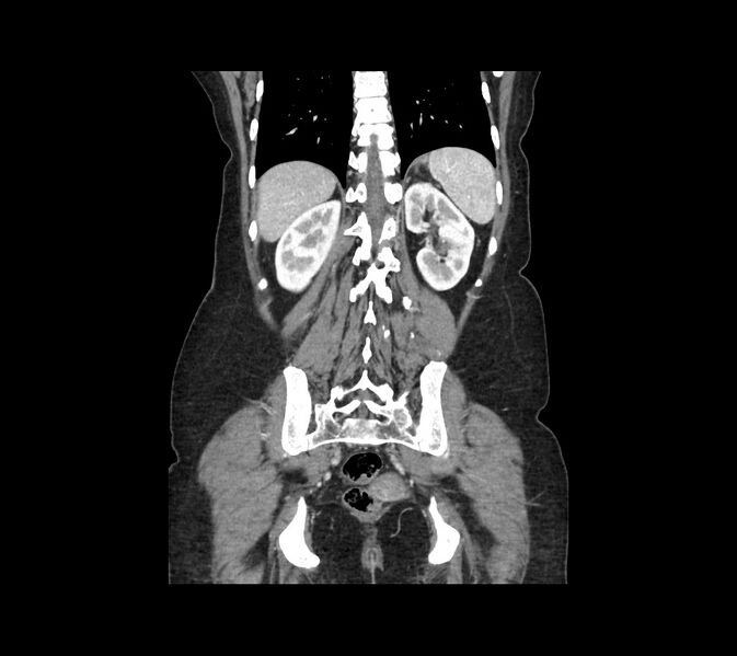File:Cocoon abdomen with possible tubo-ovarian abscess (Radiopaedia 46235-50636 B 41).jpg