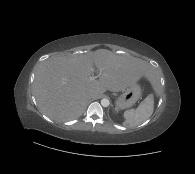File:Colonic pseudo-obstruction (Radiopaedia 79752-92980 A 39).png