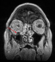 MRI head: right sided sinus involvement extending into the orbit.