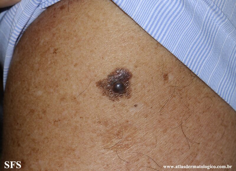 File:Melanoma (Dermatology Atlas 108).jpg