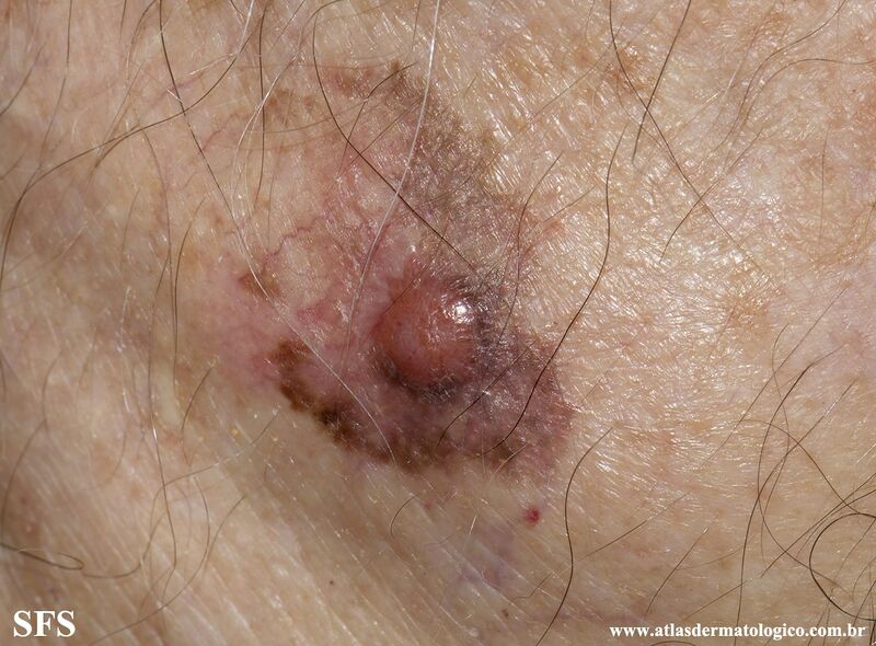File:Melanoma (Dermatology Atlas 98).jpg