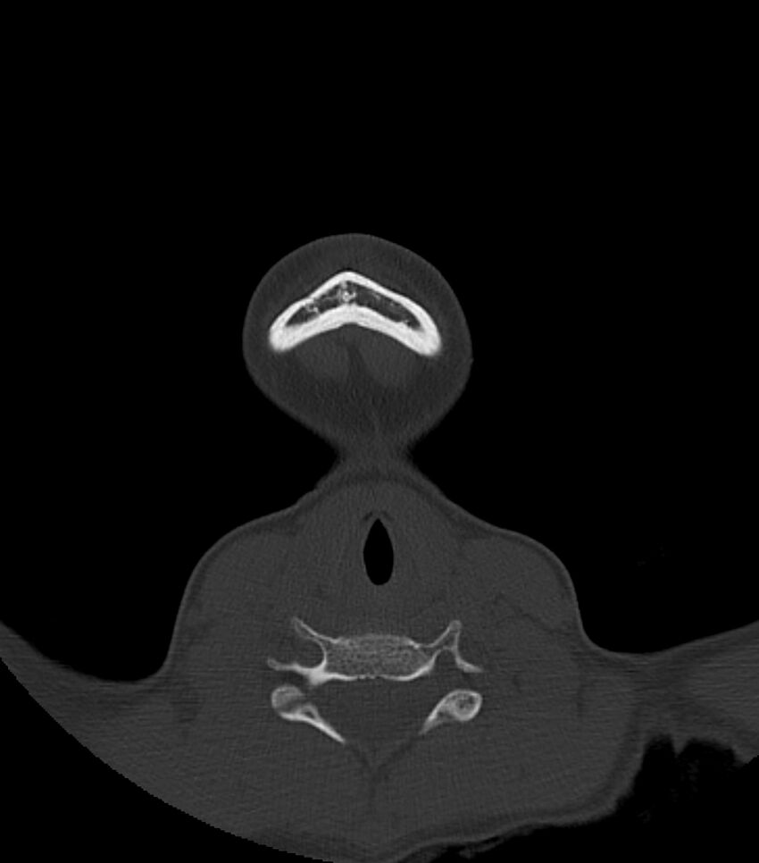 Nasoorbitoethmoid fracture (Radiopaedia 90044-107205 Axial bone window 12).jpg
