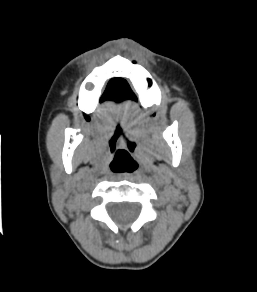 Nasoorbitoethmoid fracture (Radiopaedia 90044-107205 Axial non-contrast 90).jpg