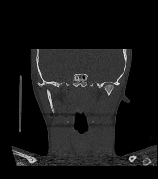 File:Nasoorbitoethmoid fracture (Radiopaedia 90044-107205 Coronal bone window 89).jpg