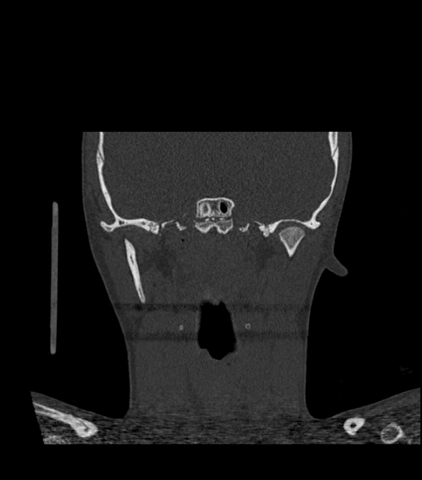 Nasoorbitoethmoid fracture (Radiopaedia 90044-107205 Coronal bone window 89).jpg