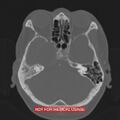 Nasopharyngeal carcinoma recurrence - skull base destruction (Radiopaedia 29107-29490 Axial bone window 78).jpg