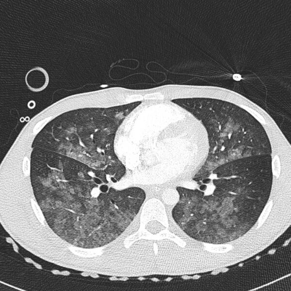 File:Near drowning (pulmonary edema) (Radiopaedia 24685-24958 lung window 39).jpg
