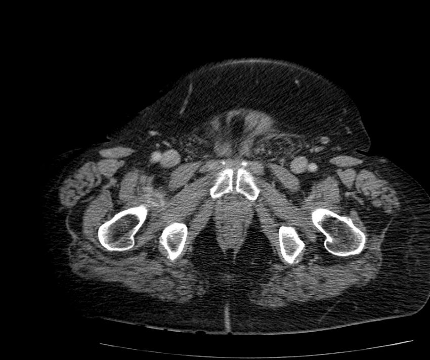 Nephroptosis with inguinal hernia containing perirenal fat (Radiopaedia 56632-63391 C 333).jpg