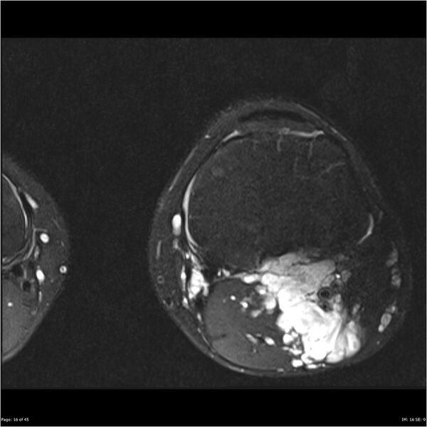 File:Neurofibromatosis type 1 (Radiopaedia 22541-22566 D 16).jpg
