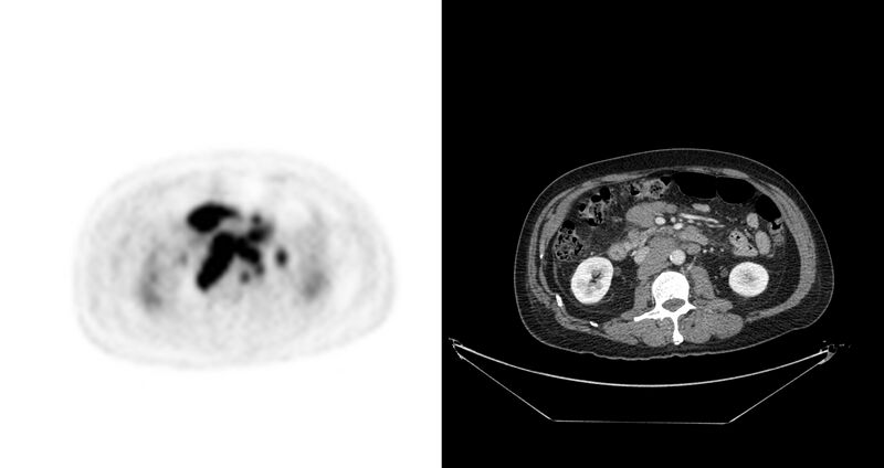 File:Non-Hodgkin lymphoma involving seminal vesicles with development of interstitial pneumonitis during Rituximab therapy (Radiopaedia 32703-33675 axial PET CT 28).jpg