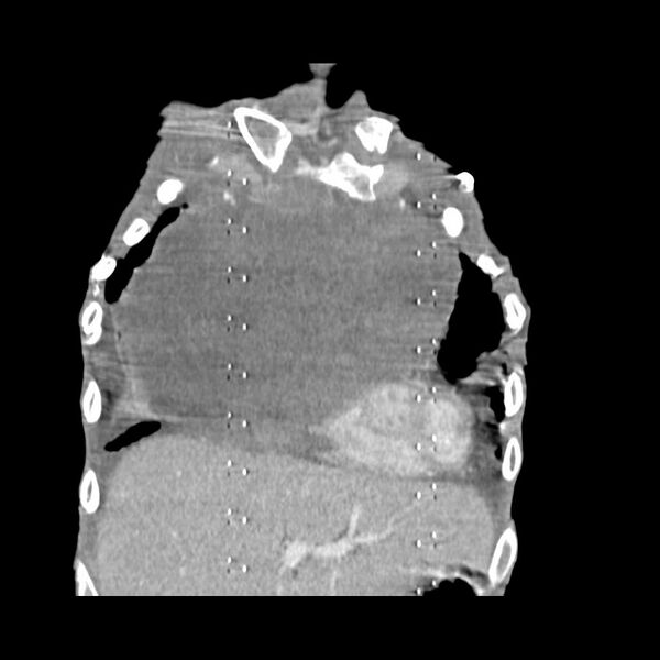 File:Non hodgkin lymphoma of the mediastinum (Radiopaedia 20814-20729 C 5).jpg