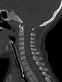 Normal CT cervical spine - pediatric (Radiopaedia 52549-58462 Sagittal bone window 98).jpg