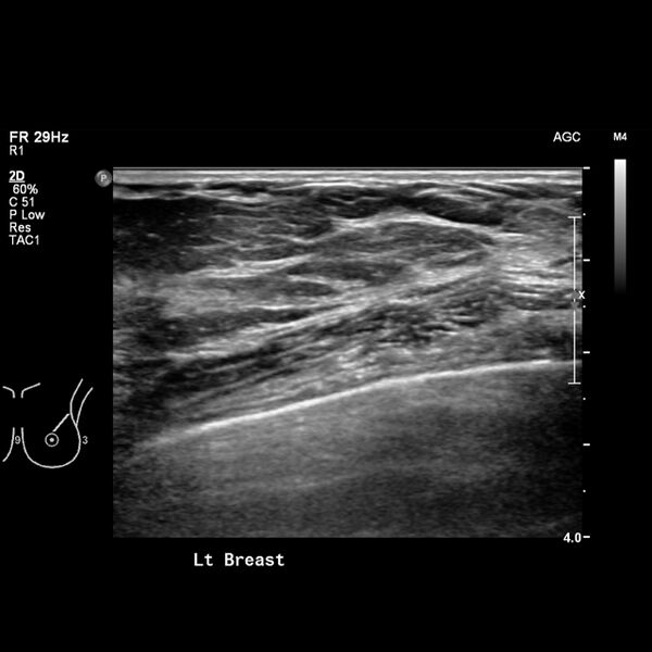 File:Normal breast mammography (tomosynthesis) and ultrasound (Radiopaedia 65325-74354 Left breast 3).jpeg