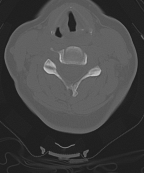 File:Normal cervical spine MRI (including Dixon) (Radiopaedia 42762-45926 Axial bone window 31).png