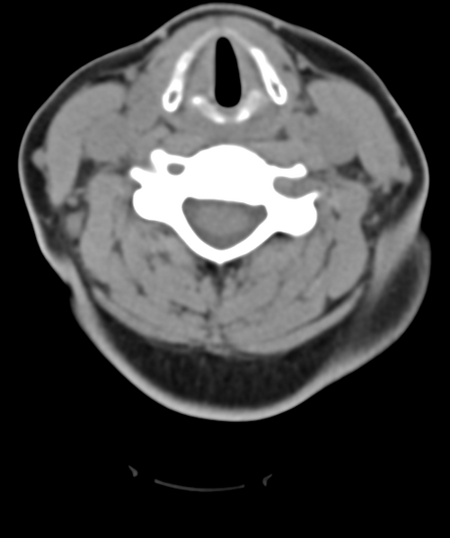 File:Normal cervical spine MRI (including Dixon) (Radiopaedia 42762-45926 Axial non-contrast 33).png