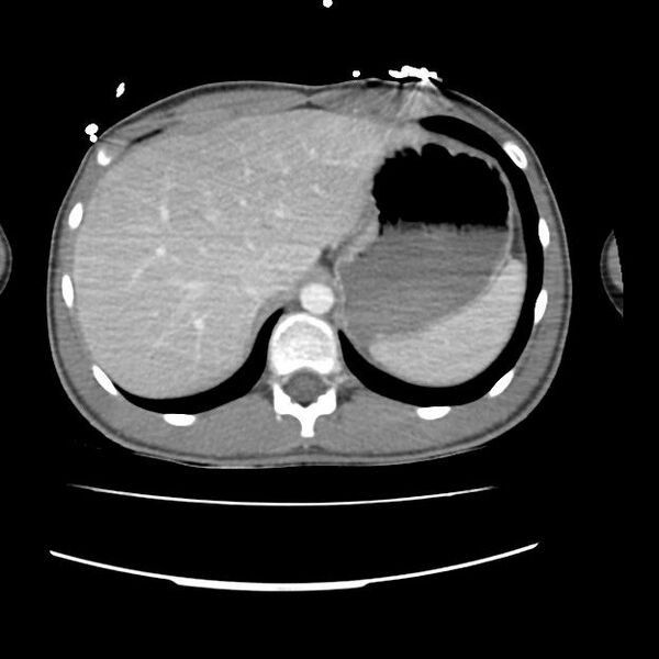 File:Normal dual-phase trauma CT chest,abdomen and pelvis (Radiopaedia 48092-52899 A 51).jpg