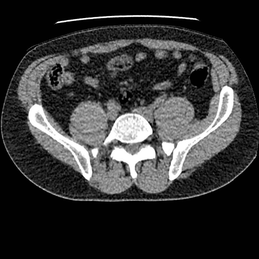 Obstructing ureteric calculus and ureteric anatomy (Radiopaedia 62730-71042 Axial non-contrast 104).jpg