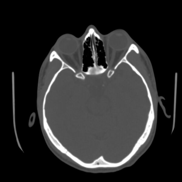 File:Occipital spur - asymptomatic (Radiopaedia 87753-104201 Axial bone window 67).jpg