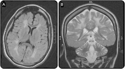 a)Extensive white matter disease b) atrophy of frontal hemispheres and cerebellum