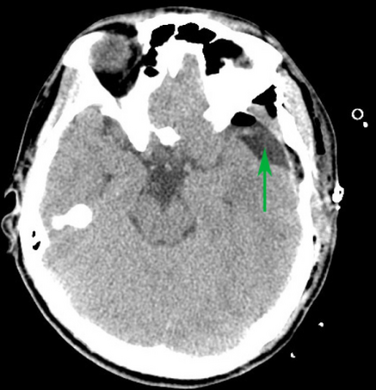 Male with complicated arachnoid cyst