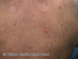 Primary cutaneous adenoid cystic carcinoma