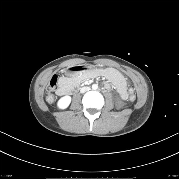 File:Traumatic renal artery dissection and pancreatic transection (Radiopaedia 37061-38739 Axial 219).jpg